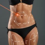 Laser-Lipolyse zur Körperkonturierung (Bildquelle: biolitec®)