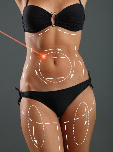 Laser-Lipolyse zur Körperkonturierung (Bildquelle: biolitec®)