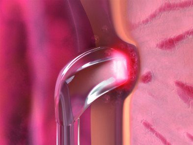 Prostatabehandlung mit XCAVATOR-Faser von biolitec (Bildquelle: biolitec®)