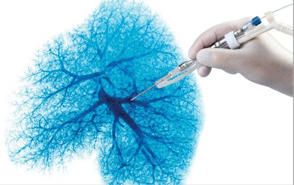 biolitec®-Laserfaser mit Handstück für die Thorax-Cirurgie (Bildquelle: © biolitec®)