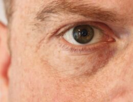 Augenärzte hoffen auf die Entwicklung von Augentropfen mit Cannabis Wirkstoffen gegen trockene Augen