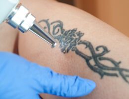 Die Laserbehandlung ist eine häufige Wahl bei der Tattoo-Entfernung. (Bildquelle: ERGO Group)