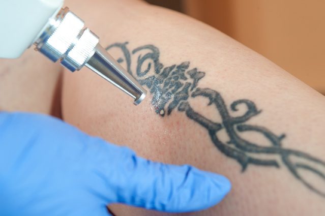 Die Laserbehandlung ist eine häufige Wahl bei der Tattoo-Entfernung. (Bildquelle: ERGO Group)