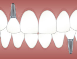 Haltbarkeit von Zahnimplantaten