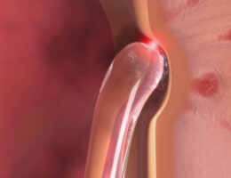Prostata-Behandlung im Kontakt-Modus mit der TWISTER-Laserfaser der biolitec (Bildquelle: © biolitec®)