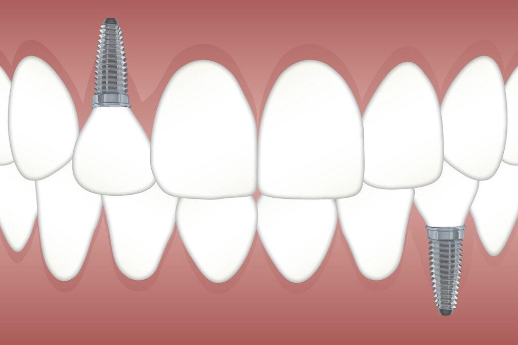 Die verschiedenen Zahn-Implantate