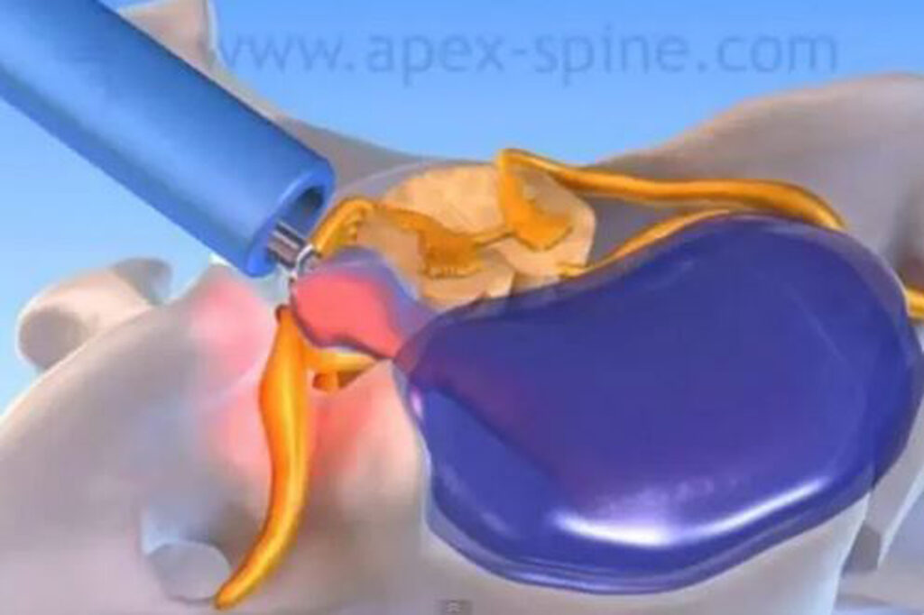 Apex-Spine Mikroforaminotomie