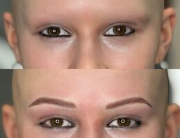 Jugendliche mit Alopezie - vorher und nach Permanent Make Up Behandlung (Die Bildrechte liegen bei dem Verfasser der Mitteilung.)