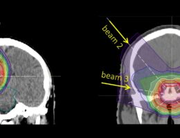 Protonentherapie gegen Tumoren im Bereich des ZNS und der Schädelbasis schonend für umgebendes Hirngewebe